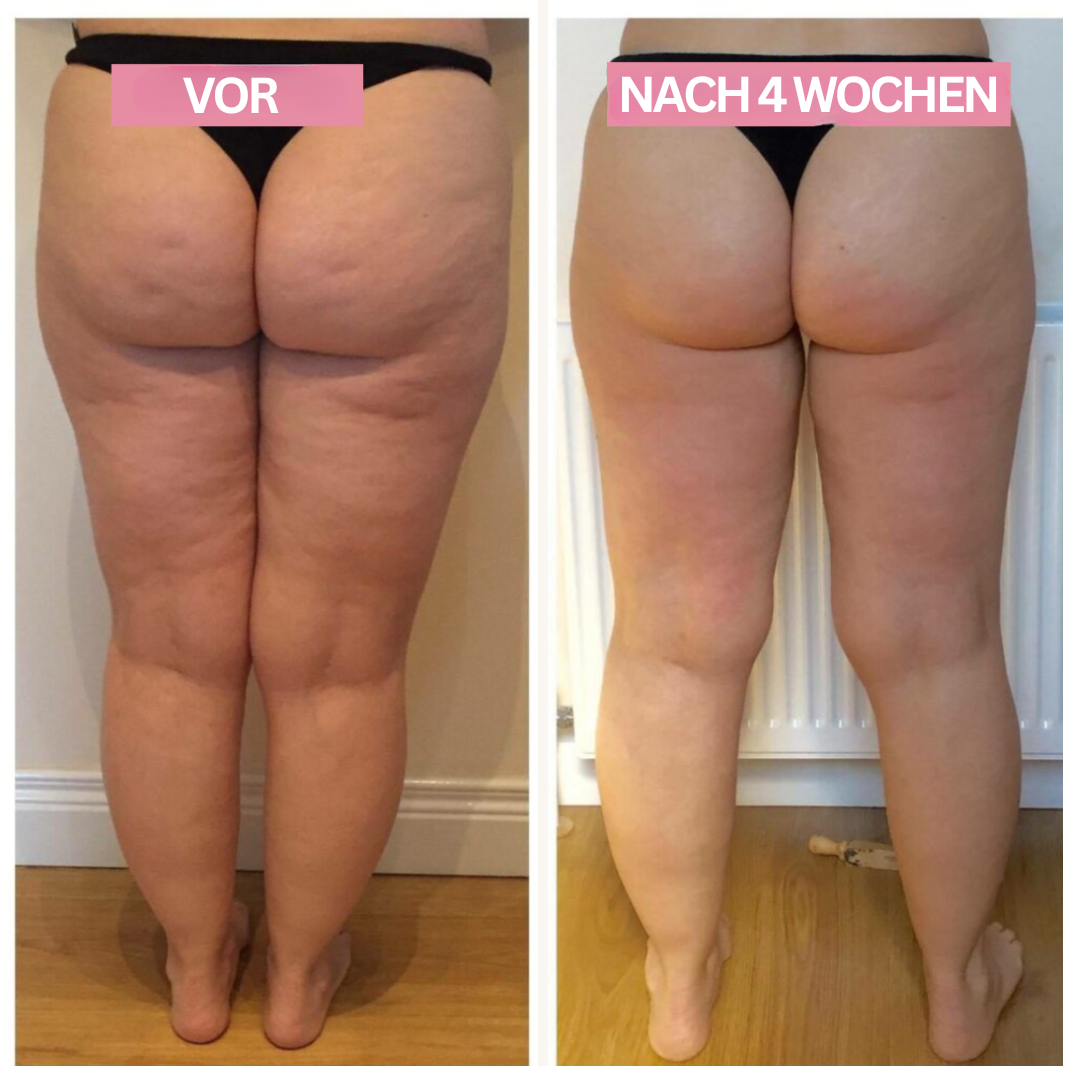 GlowNow™ Cellulite Massager