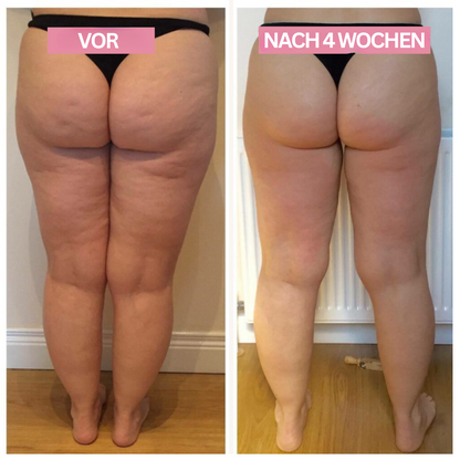 GlowNow™ Cellulite Massager